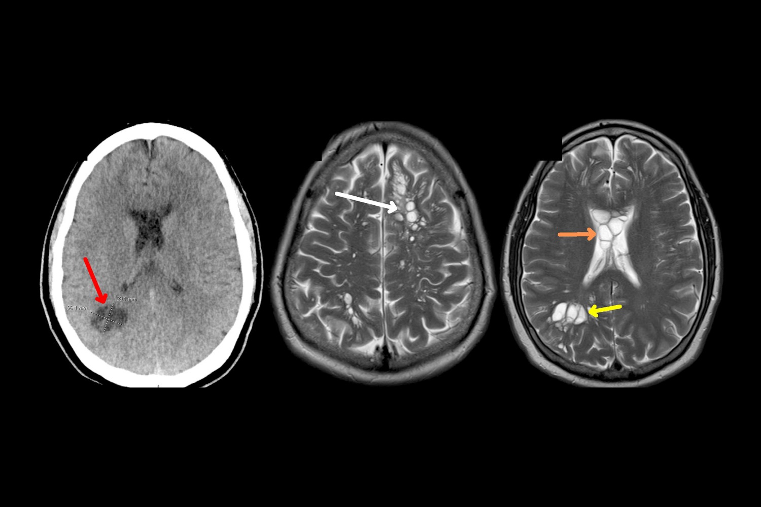 Undercooked Bacon: An Unexpected Culprit Behind Severe Migraines and Brain Tapeworms Undercooked Bacon: An Unexpected Culprit Behind Severe Migraines and Brain Tapeworms