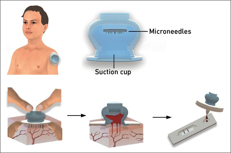 Revolutionizing Blood Sampling: The Leech-Inspired Device Changing the Game