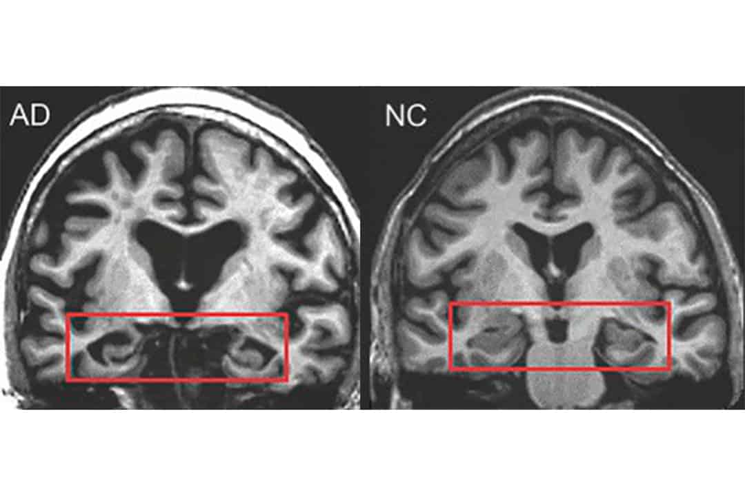 Bilingualism: Your Brain’s Best Defense Against Dementia Revealed